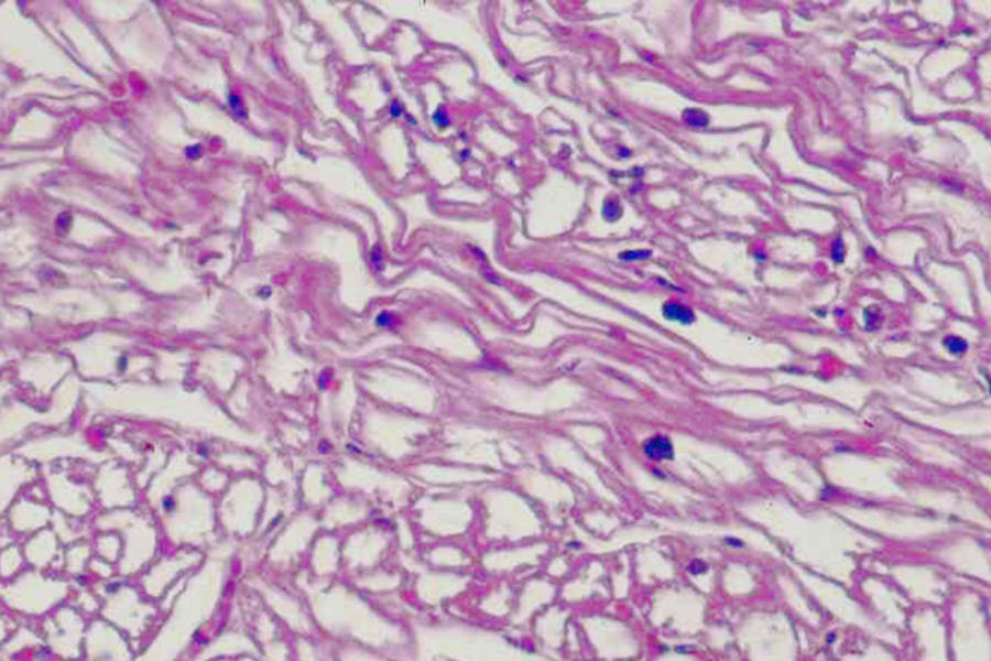 Glykogen-Speicherkrankheit