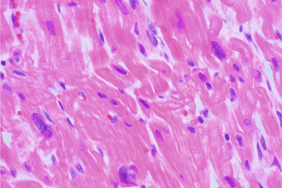 hypertensive Herzkrankheit