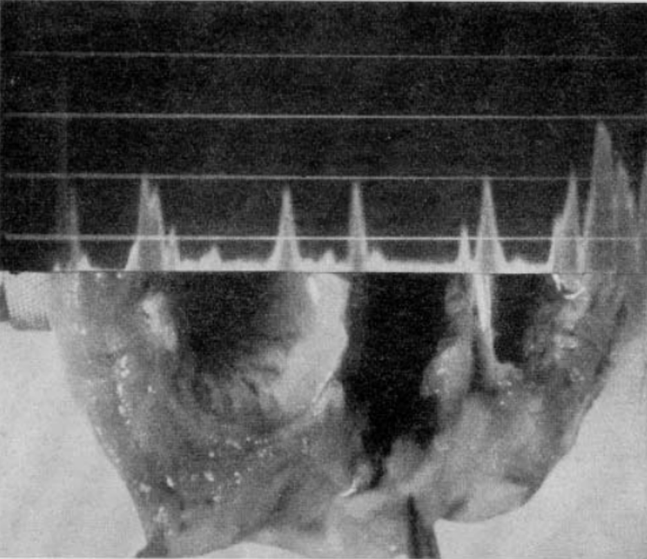 Edler-Echokardiographie