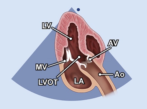subcostale Schnittebene